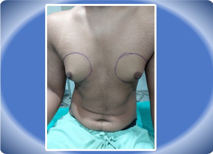 GYNAECOMASTIA