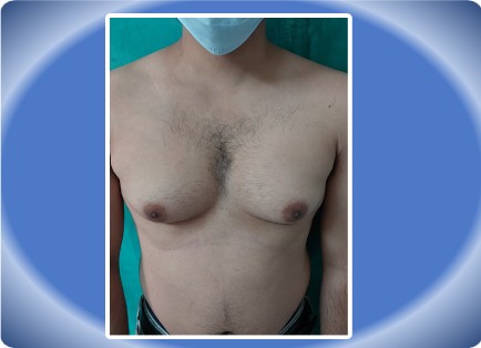 GYNAECOMASTIA