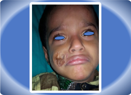 HAEMANGIOMA