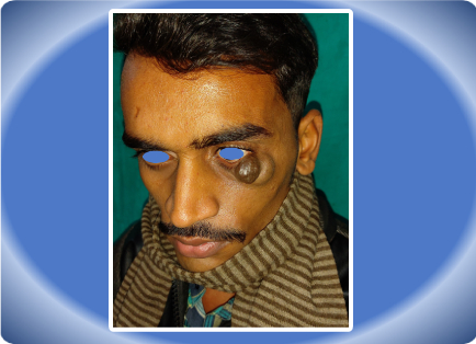 HAEMANGIOMA