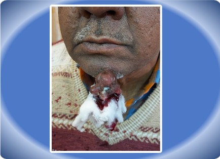 HAEMANGIOMA