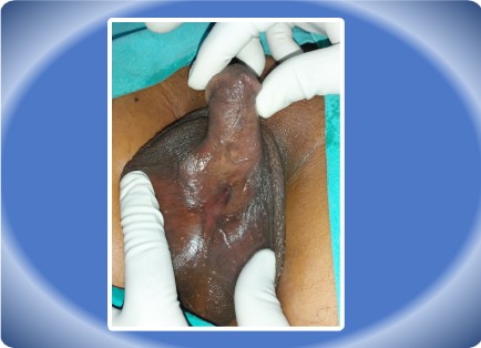HYPOSPADIAS