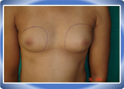 LIPOSUCTION