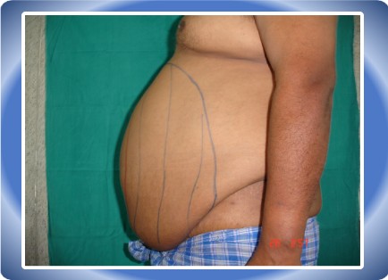 LIPOSUCTION