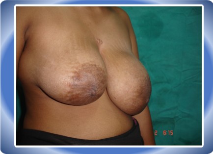 MAMOPLASTY