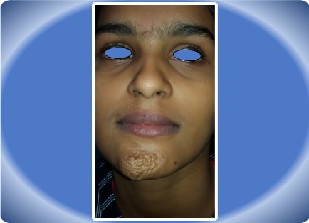 NEUROFIBROMA