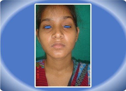 PTOSIS