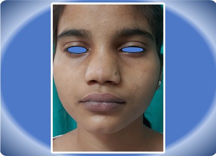 RHINOPLASTY