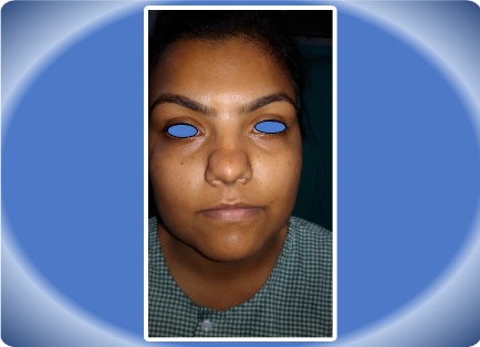 RHINOPLASTY