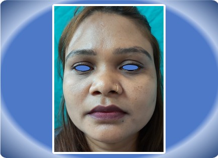 RHINOPLASTY