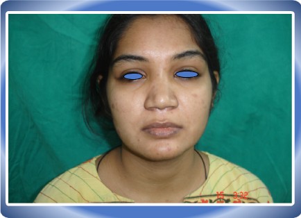 RHINOPLASTY