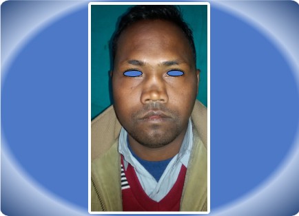 RHINOPLASTY