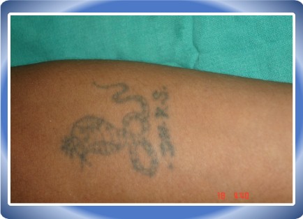 Tatoo