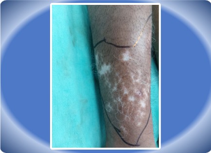 VITLIGO